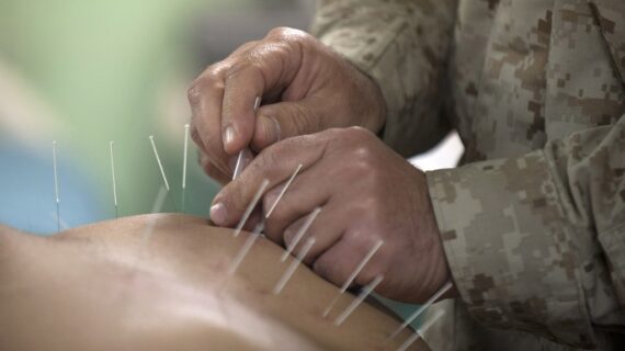 Everything You Need to Know About Acupuncture